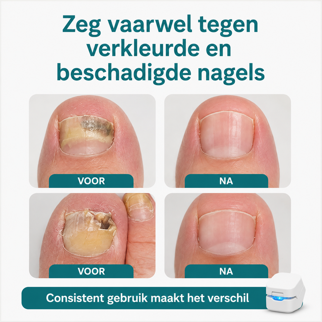 Nailvia™ |  Nagelverzorging door lichttechnologie