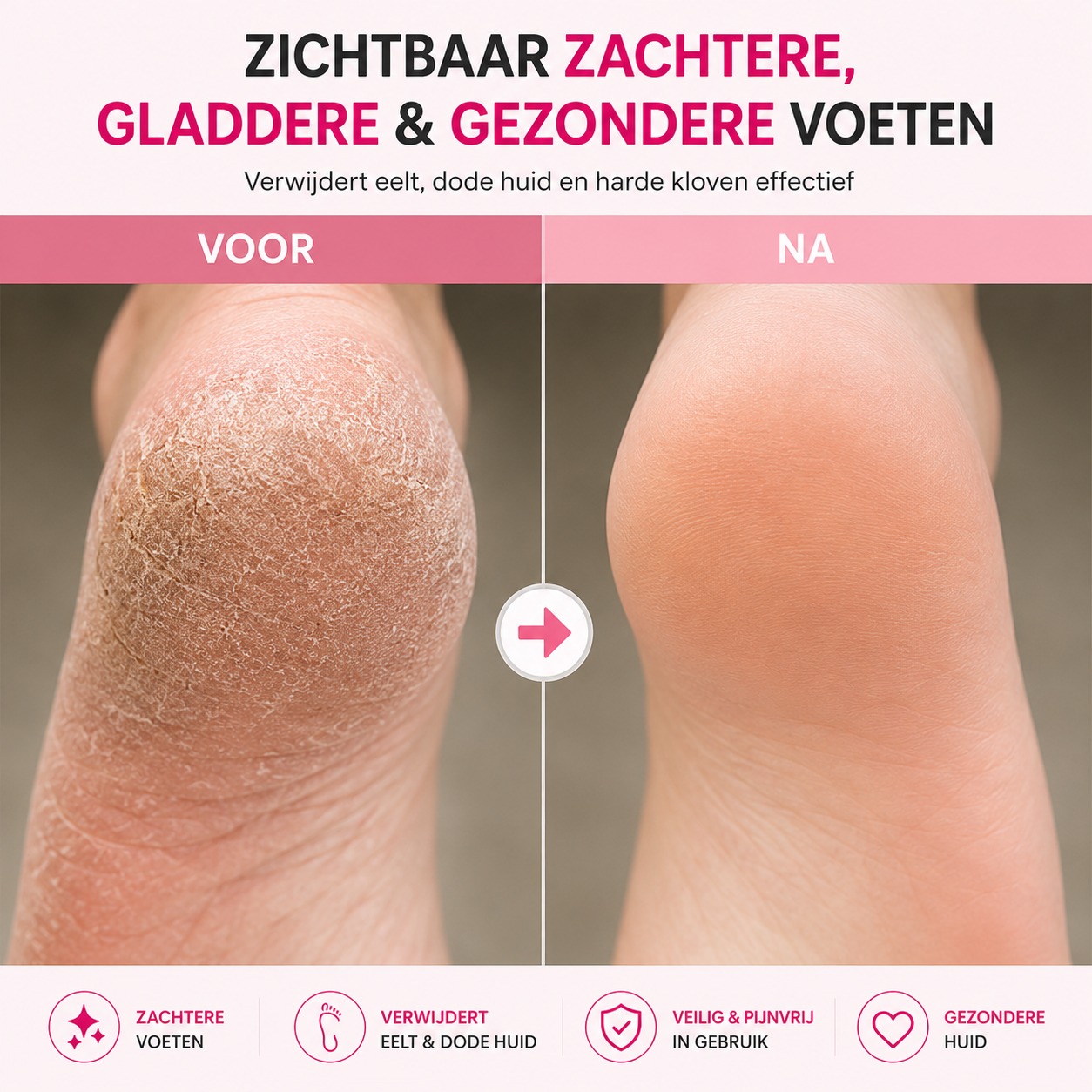 Veloura™ Elektrische Eeltverwijderaar