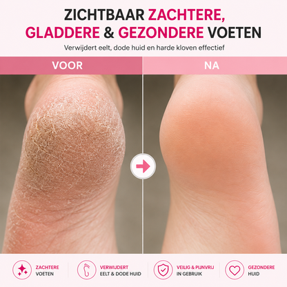 Veloura™ Elektrische Eeltverwijderaar